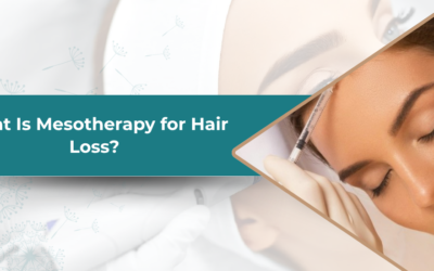 What Is Mesotherapy for Hair Loss?