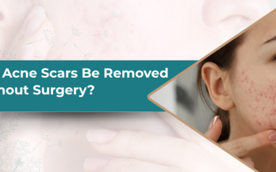 Can Acne Scars Be Removed Without Surgery?