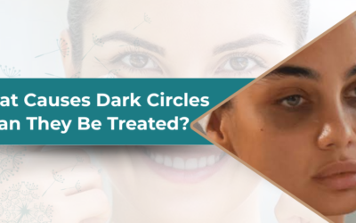 What Causes Dark Circles and Can They Be Treated?
