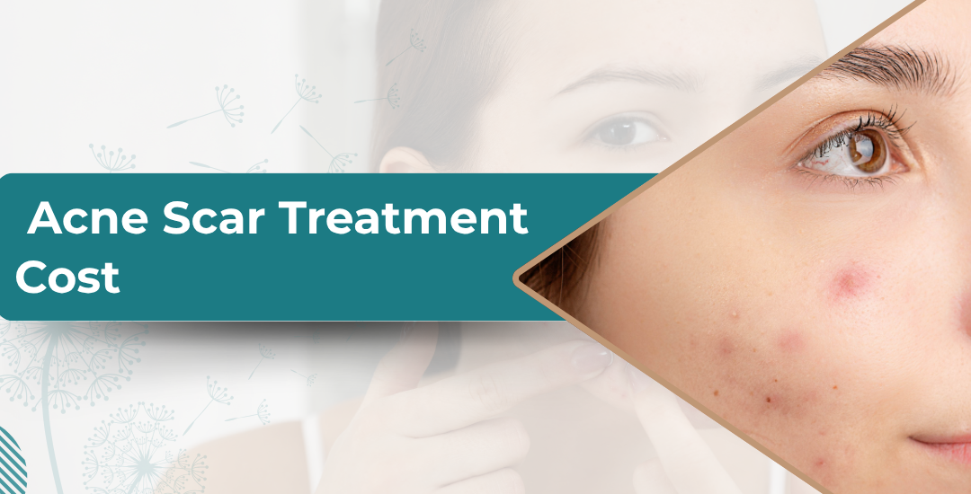 How Much Does Acne Scar Treatment Cost?